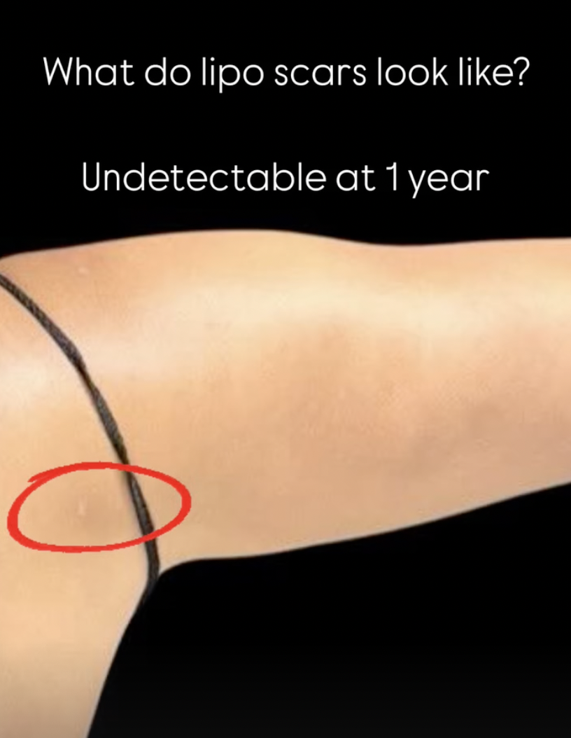 LIPO SCAR